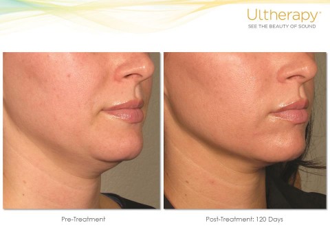 ultherapy-1