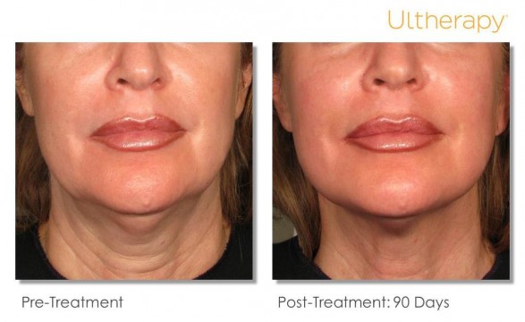 ultherapy-2