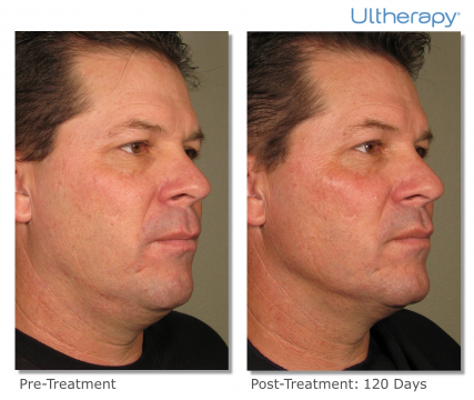 ultherapy-3